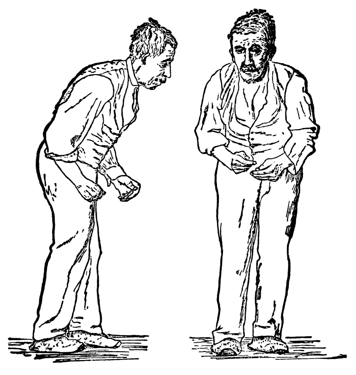 兩幅插畫分別由前面和右側描繪了罹患巴金森氏症患者，面無表情、彎腰駝背、舉步維艱。此圖為William Richard Gowers繪製，首見於其1886年出版的《神經系統疾病手冊》（A Manual of Diseases of the Nervous System）。（取自https://zh.wikipedia.org/w/index.php?curid=5458640）